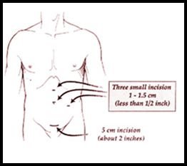 Laparoscopic Procedure