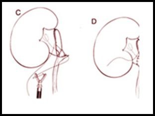 Laparoscopic dismembered pyeloplasty