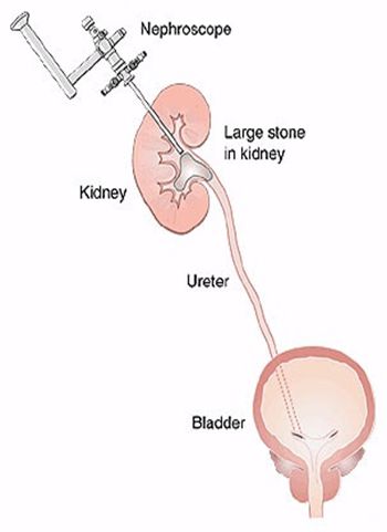 percutaneous lithotripsy