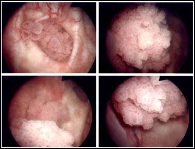 Stages of Bladder Cancer