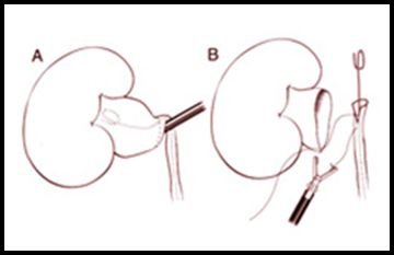 Ureteropelvic Junction (UPJ) Obstruction