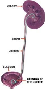 Urinary Tract Double J Stent