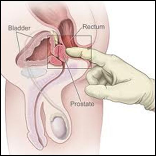 prostate cancer prostate cancer