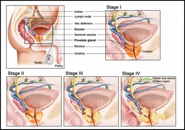 stage of the prostate cancer